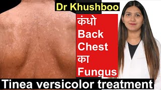 Tinea Versicolor Treatment  सेहुआ करोडियासीप Tinea body fungus treatment [upl. by Dlorad812]