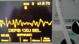 Kirtipur Hospital Nepal demo of Zoll series M defibrillator [upl. by Aimerej383]