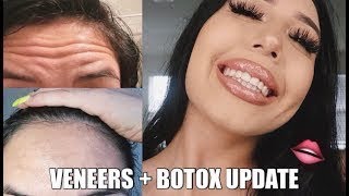 I GOT VENEERS  BOTOX UPDATE [upl. by Gney]