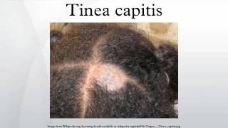 Tinea capitis [upl. by Lukin]