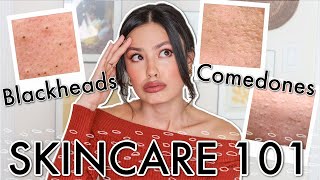 The TRUTH About Blackheads Comedones amp Congested Skin 👏🏻 ✨ Treatment and Prevention [upl. by Mae]