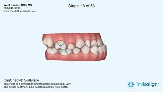 Underbite correction with Invisalign and without Surgery [upl. by Harriet]