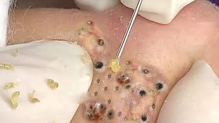 Satisfying Videos  Pimples Popping  Blackheads  Acne amp Cysts Compilation 109 [upl. by Acilgna]