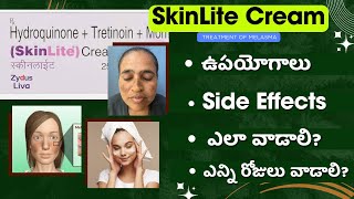 How to Use Skinlite Cream for Melasma  Benefits Side Effects and Precautions [upl. by Aruat]