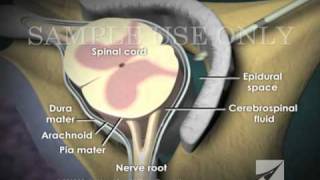 Loss of Pressure Epidural Injection [upl. by Anyotal560]