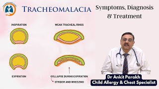 Tracheomalacia in children Symptoms Diagnosis amp Treatment I Dr Ankit Parakh Child Pulmonologist [upl. by Deering]