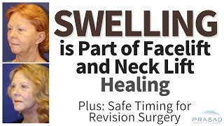 Why Swelling from Face and Neck Lifts Need to Resolve Before Revision and Advanced Healing Methods [upl. by Lemrahc]