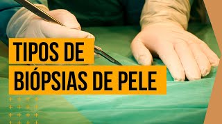 ✅ TIPOS DE BIÓPSIAS NO CÂNCER DE PELE  Saiba quais são e como são feitas [upl. by Edmonds870]