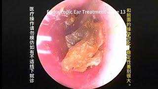 Cerumen embolism is more common in children than in adults [upl. by Nodearb]