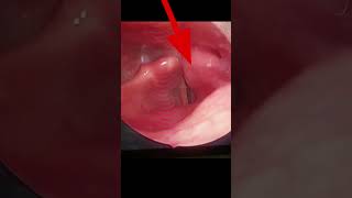 Normal Larynx vs Larynx Cancer  Fixed vocal cord Hoarse voice  आवाज़ ख़राब होना shorts viral [upl. by Aurilia16]