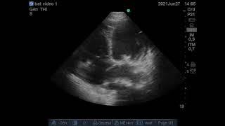 CardioMyopathie Dilatée HTAP post capillaire Échographie [upl. by Coy946]