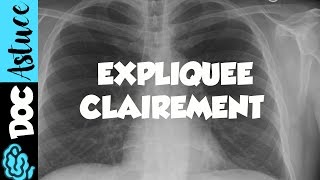 🔴 4 Dr Astuce  ANOMALIES RADIO THORAX EXPLIQUÉES CLAIREMENT  PARTIE 2 [upl. by Mode]