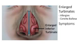 Enlarged Nasal Turbinates Symptoms and Treatment [upl. by Stillman]