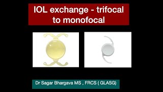 Intraocular Lens Exchange  IOL EXCHANGE from Trifocal to Monofocal  Dr Sagar Bhargava [upl. by Carberry898]