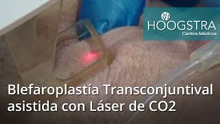 Blefaroplastía Transconjuntival asistida con Láser de CO2 16057 [upl. by Ainotna]