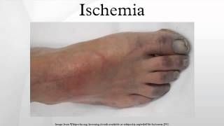 Ischemia [upl. by Aneen]