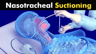 How Nasotracheal suction is performed [upl. by Ysset406]