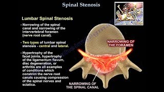 Lumbar Spinal Stenosis  Everything You Need To Know  Dr Nabil Ebraheim [upl. by Sigsmond271]