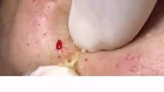 ACNE UNDER SKIN EXTRACTION  GREAT HIDDEN ACNE ON CHEEK part 4 [upl. by Lady96]