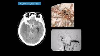 Imaging subarachnoid hemorrhage [upl. by Lothaire774]