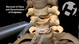 CERVICAL SURGERY C5C6C7 [upl. by Eusebio]