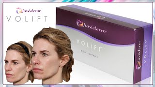 Lip and Cheek Filler Juvederm Volift with Before and After Pictures [upl. by Htezzil]