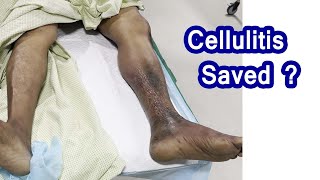 cellulitis infection  Necrotizing Fascitis Healing Stages [upl. by Chaddie]