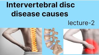 Intervertebral disc disease causes Intervertebral disc disease [upl. by Silletram25]