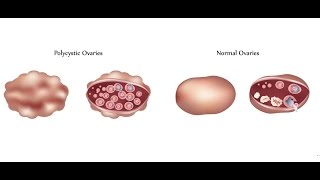 Polycystic Ovary Syndrome PCOS [upl. by Atirys206]