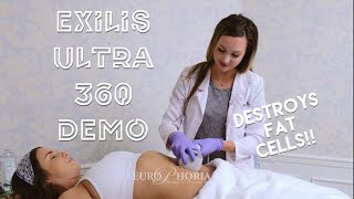 EXILIS ULTRA DEMONSTRATION BODY  Exilis Ultra 360 Experience at EuroPhoria [upl. by Naujed280]