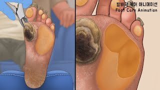 ASMR 딱딱하게 굳고 갈라진 발바닥을 깨끗하게 과각화증 사마귀 굳은살 티눈 제거 애니메이션  Calluses Plantar Warts Corn [upl. by Adnilreb341]