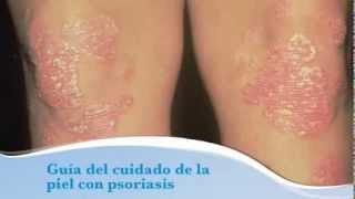 Guia del cuidado de la piel con psoriasis [upl. by Lachus]