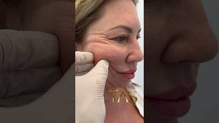 20 Years Back with Scarless Facelift by ProfDrSuleyman Tas facelift drsuleymantas [upl. by Laurena]