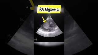 Parasternal short Axis View showing RA myxoma on Echocardiography heart tumor [upl. by Dorina]