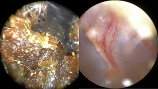 139  Severe Ear Wax Blockage Removed using WAXscope®️amp New Mechanical Instruments [upl. by Cort]