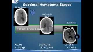 Traumatic Brain Injury Part 2 [upl. by Squires554]