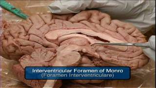 Mammillary Body Fornix Foramen of Monro Pineal Gland Tectum From quotDissection of the Brainquot DVD [upl. by Terencio400]