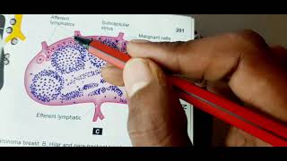 Metastasis and routes of metastasis mbbs pathology [upl. by Adali773]