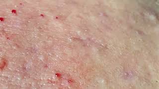 Acne Treatment Huong Da Nang  2024 blackheads 706 [upl. by Jim]