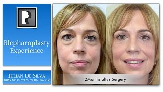 My personal experience of upper and lower blepharoplasty with Dr Julian De Silva [upl. by Theurer987]