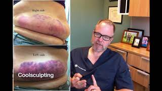 Sculpsure vs Coolsculpting  Which One is Better [upl. by Annhoj]