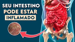 INTESTINO INFLAMADO Sintomas de Doença Inflamatória Intestinal │ Doença de Crohn [upl. by Yblocaj862]