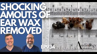 SHOCKING AMOUNTS OF EAR WAX REMOVED  EP934 [upl. by Apostles645]