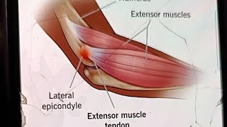 Lateral Epicondylitis Tennis Elbow treatment [upl. by Liagabba842]