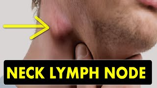 NECK LYMPH NODES  CAUSES and TREATMENT [upl. by Imot941]