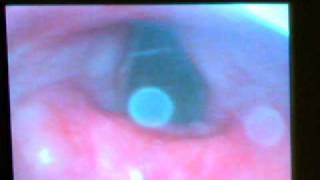 Tulip Airway  Bronchoscopy Video [upl. by Aneba496]