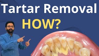 Tartar Removal from Teeth  Dental Teeth Cleaning [upl. by Leggat]