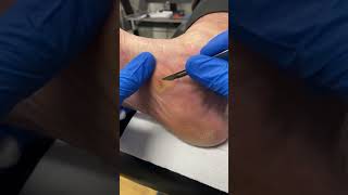 Learn how a Podiatrist expertly removes Medial Foot Callus Removal  Corn and Callus Treatment [upl. by Hogle]