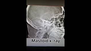 mastoid x ray ear x ray radiology shortvideo [upl. by Genevieve593]