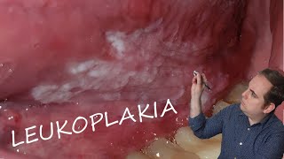 Leukoplakia Common Oral Pathology [upl. by Peednas]